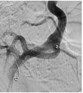 Arterial Interventions.
