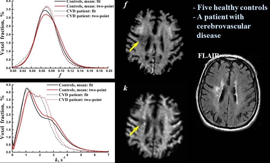 Cross relaxation imaging of stroke.