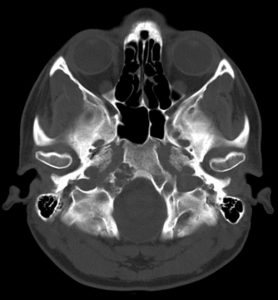 CT axial bone windows.