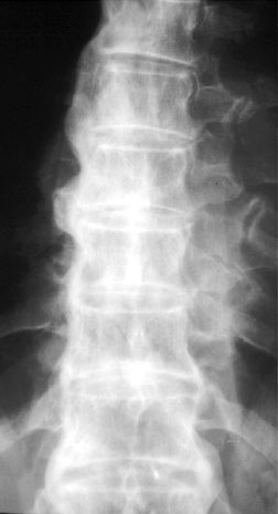 DDD APT Spine.
