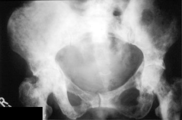 Diffuse Mets Pelvis.