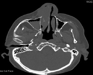 CT axial bone windows.