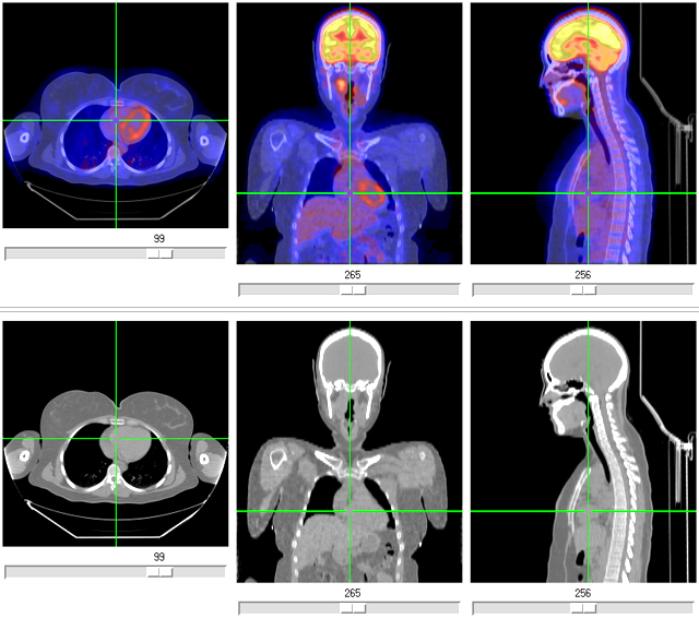 PET/CT scanner and patient.