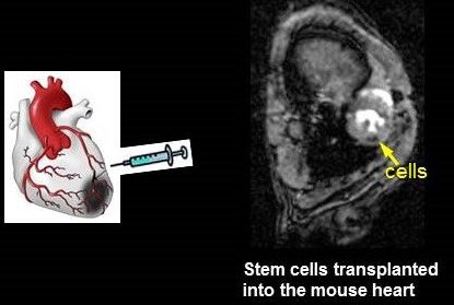 Stem cells transplated.