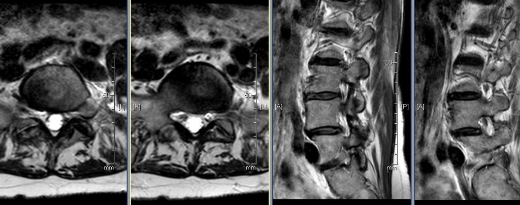 T2 axial at L5/S1    T2 sagittal at left side.