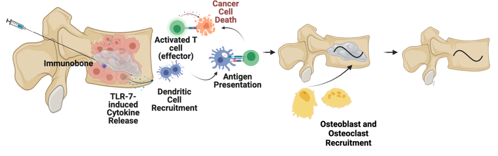 Schematic displaying the ImmunoBone treatment platform for cancer immunotherapy in bone metastases.